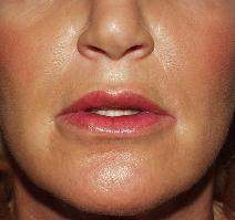 Hyaluronic Acid After